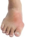 Is Marijuana Good for Gout?